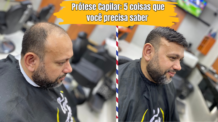 Prótese Capilar: 5 coisas que Você Precisa Saber