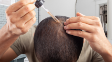 3 Segredos do Minoxidil: Como Combater a Queda de Cabelo