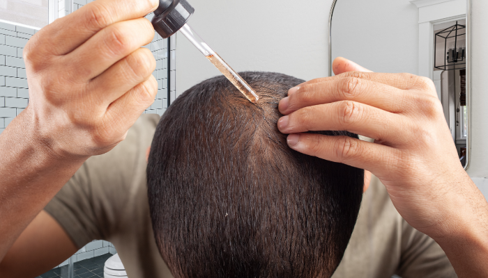 3 Segredos do Minoxidil: Como Combater a Queda de Cabelo